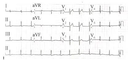協和疑難︱第67例：臨床表現胸痛伴肌酸激酶升高