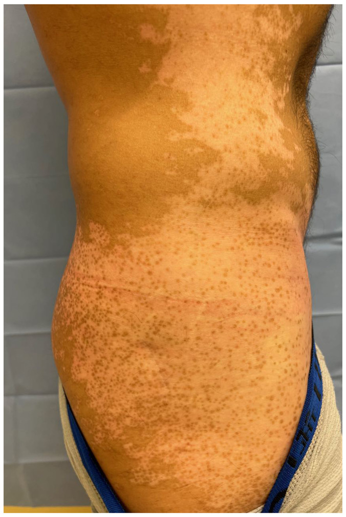 白癜風(fēng)大面積毛囊周?chē)爻林? loading=