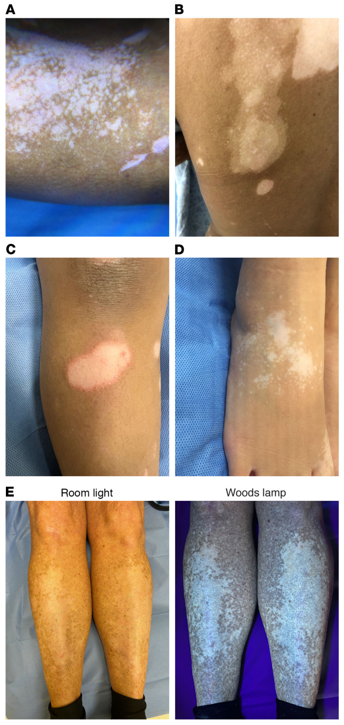 圖 2. 活動(dòng)性白癜風(fēng)病變的臨床癥狀及其基因檢測(cè)