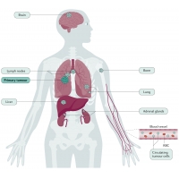 【佳學(xué)基因檢測】小細(xì)胞<font color='red'>肺癌</font>基因檢測：知識、背景與依據(jù)