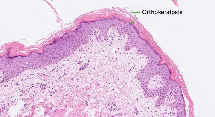 圖3. 魚鱗病皮膚活檢的組織病理學(xué)。