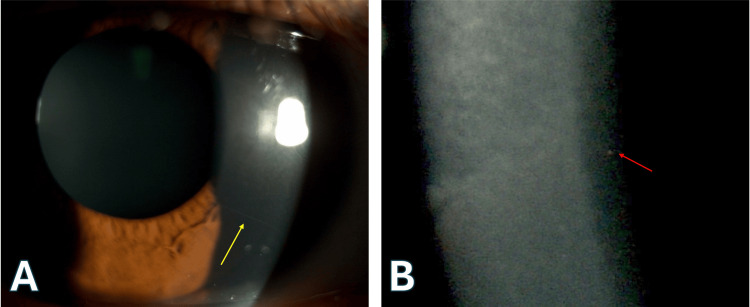 圖2. 明顯的角膜神經(jīng)和點(diǎn)狀深層基質(zhì)混濁。